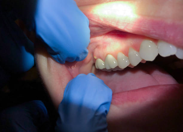 Best Emergency Dental Care for Abscessed Tooth in Acton, CA