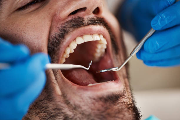 Best Emergency Dental Extractions in Acton, CA